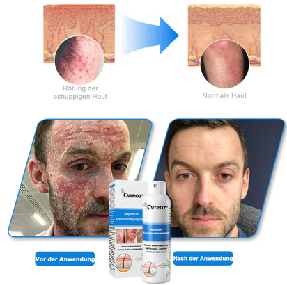 Hypochlorous Facial Spray for Acne & Redness Relief