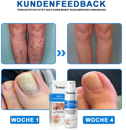 Hypochlorous Facial Spray for Acne & Redness Relief