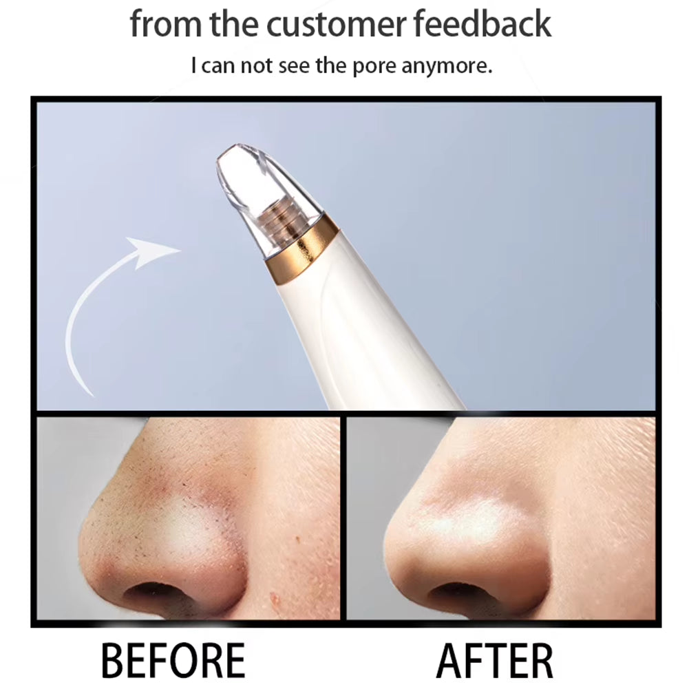Electric Face Blackhead Remover Facial Pore Acne Pimple Removal Skin Care Device